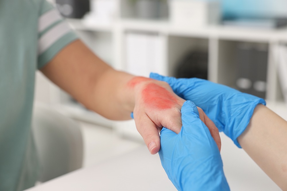 Severe burn injury on a victim’s arm from a workplace accident, highlighting the need for burn injury legal assistance.